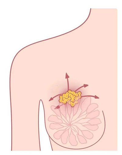 乳腺结节一定要手术吗?重庆中医肿瘤专家石毓斌:治疗乳腺结节更好的方法它来了
