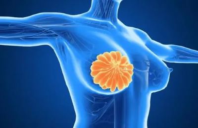 重庆乳腺结节老中医罗登祥:乳腺结节的危害和治疗方法