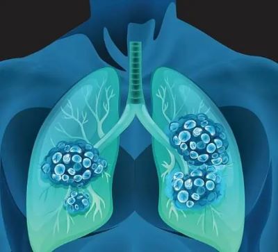 中医治疗肺磨玻璃结节有哪些误区?又有哪些注意事项