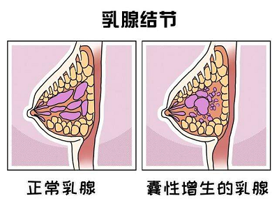 中医治疗乳腺结节