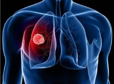 重庆治疗肺癌靠谱的中医院是哪家?