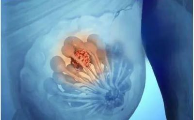 重庆结节病中医医师罗登祥:讲解乳腺结节存在哪些潜在危害