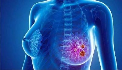 重庆乳腺结节老中医罗登祥:乳腺增生与乳腺结节有什么区别