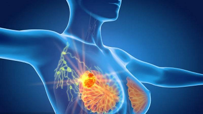 重庆哪家老中医治疗乳腺结节好?