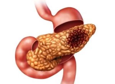 重庆治疗胰腺癌哪家中医馆效果好?