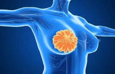 重庆结节病医馆科普|乳腺结节有哪些症状?有什么注意事项?